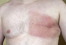 पुरुषलाई पनि हुन सक्छ ब्रेस्ट क्यान्सर, कसरी गरीन्छ उपचार ?