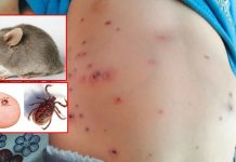 स्क्रब टाइफसको कारण दुईको मृत्यु, ९९ सङ्क्रमित