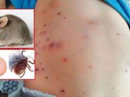 स्क्रब टाइफसको कारण दुईको मृत्यु, ९९ सङ्क्रमित