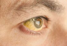 के कारणले लाग्छ जण्डिस ? यसबारे भ्रम र यथार्थ