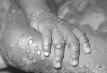 साउदीबाट फर्किएका थप एक नेपालीमा मंकीपक्स पुष्टी