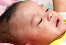 बाँकेमा फैलिएको दादुरा एक महिनापछि नियन्त्रणमा, २६० जना बालिबालिका प्रभावित