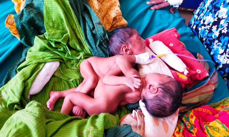 दुखनीदेवीले  जन्माइन्  छाती जोडिएका जुम्ल्याहा
