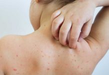 १७ जिल्लामा फैलियो दादुरा, एक हजार २१ जना संक्रमित